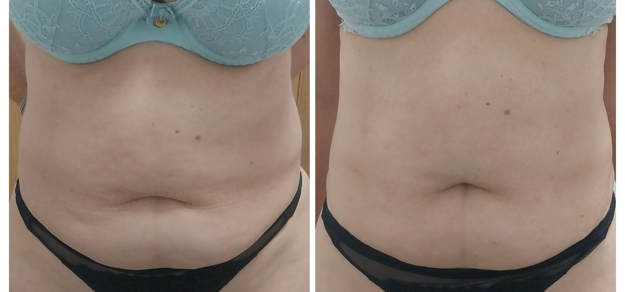 Tratamento de gordura localizada