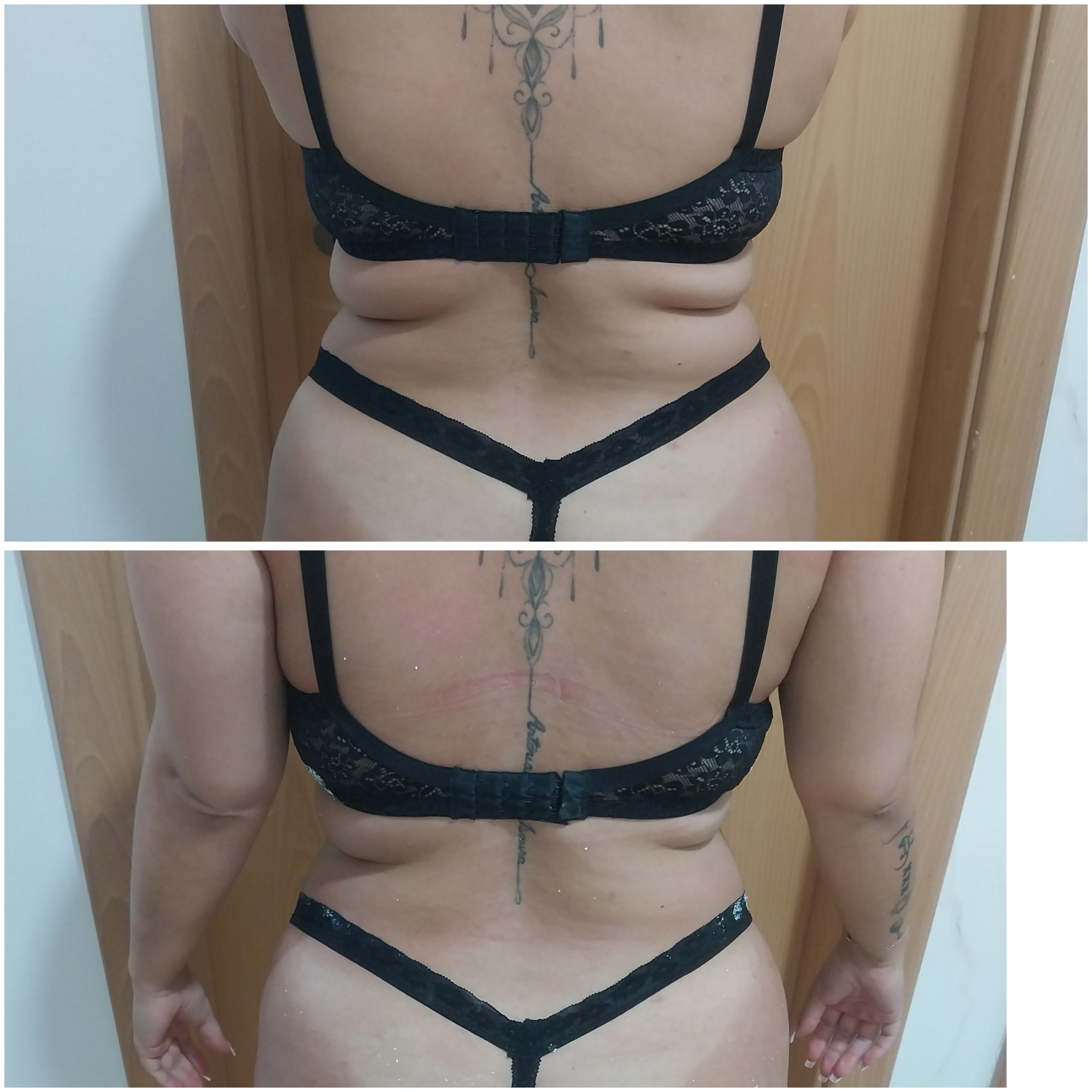 Tratamento de gordura localizada