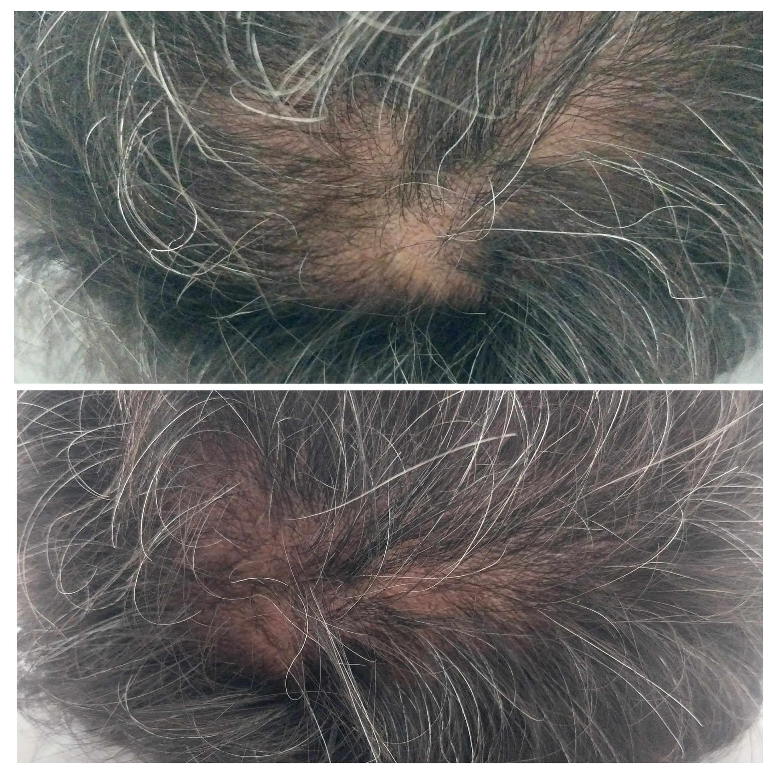 Tratamento Capilar com Fisioterapia Dermato-Funcional