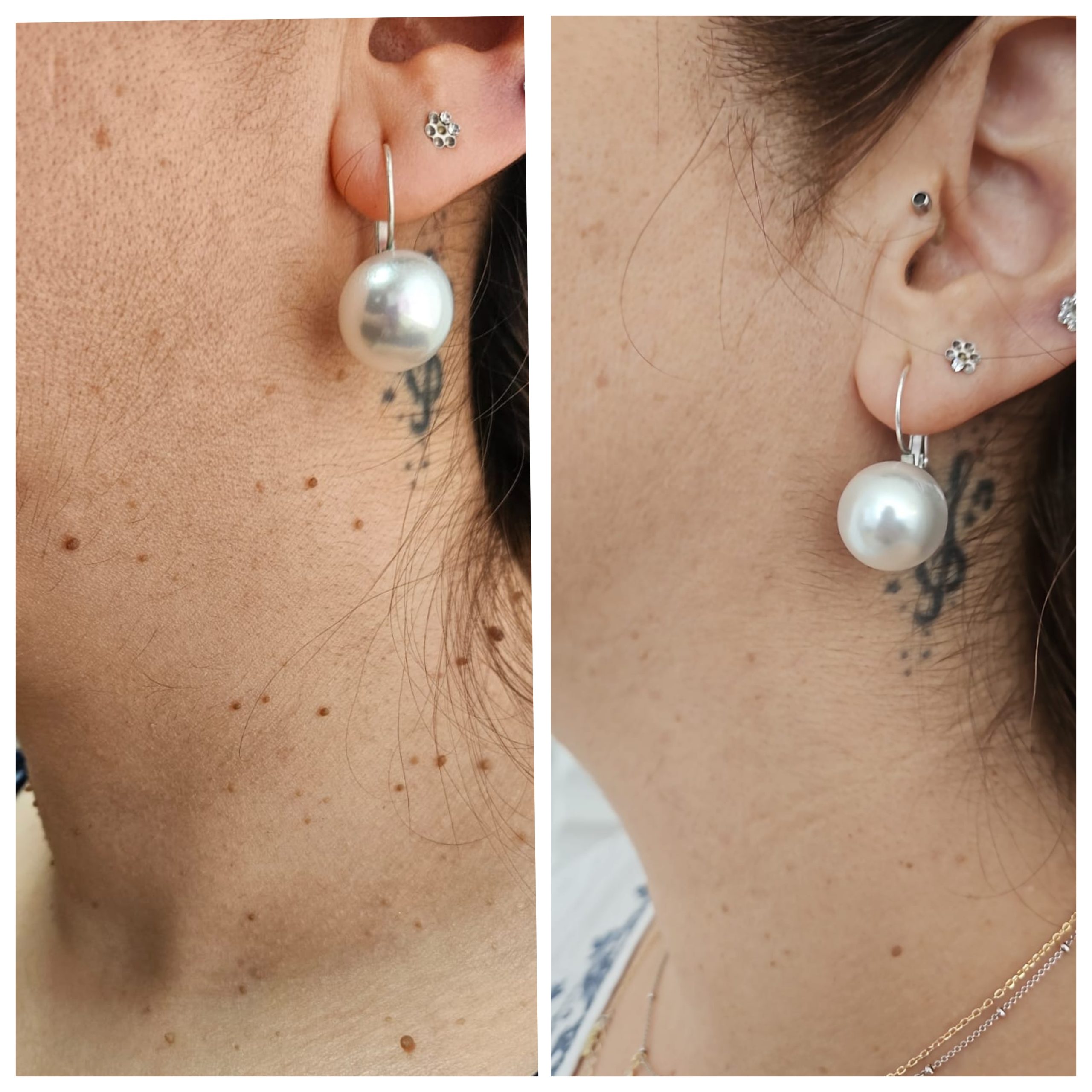 Remoção de sinais e verrugas