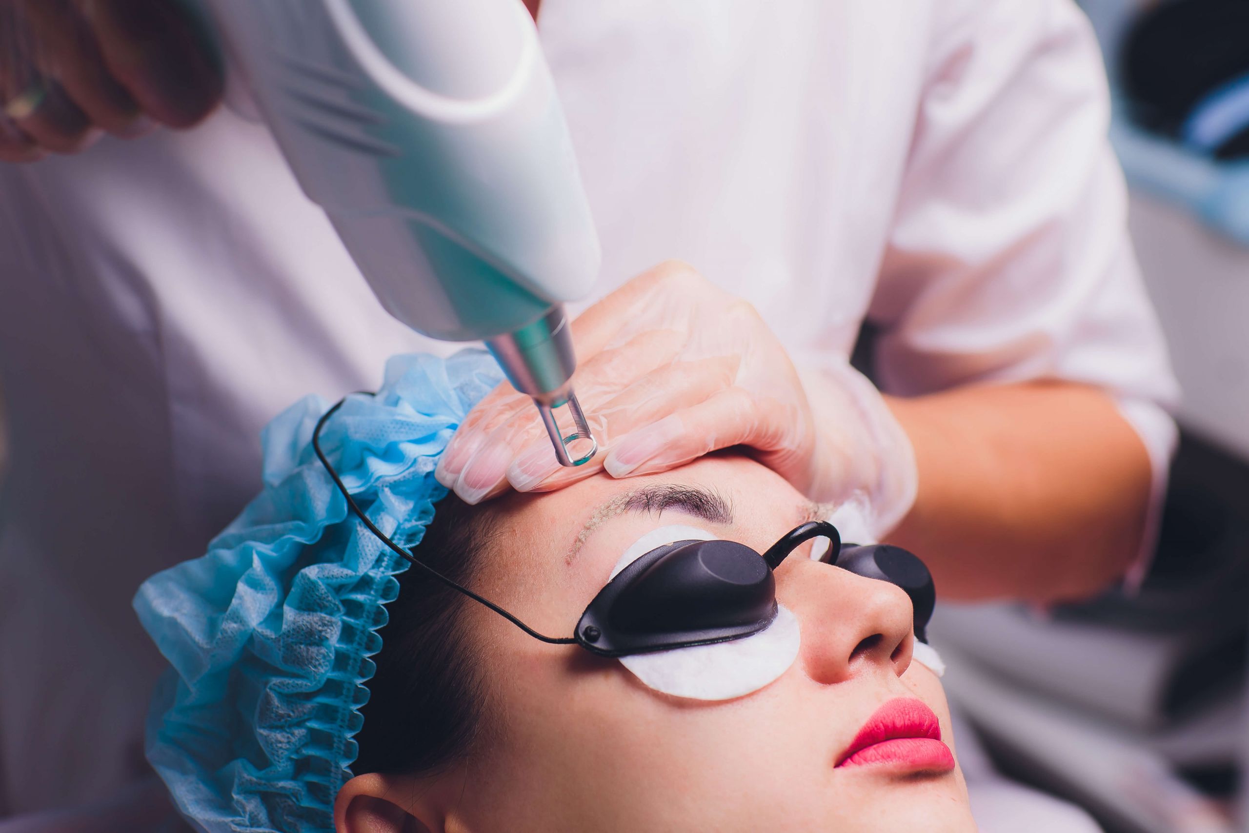 Remoção de Micropigmentação de Sobrancelhas a Laser