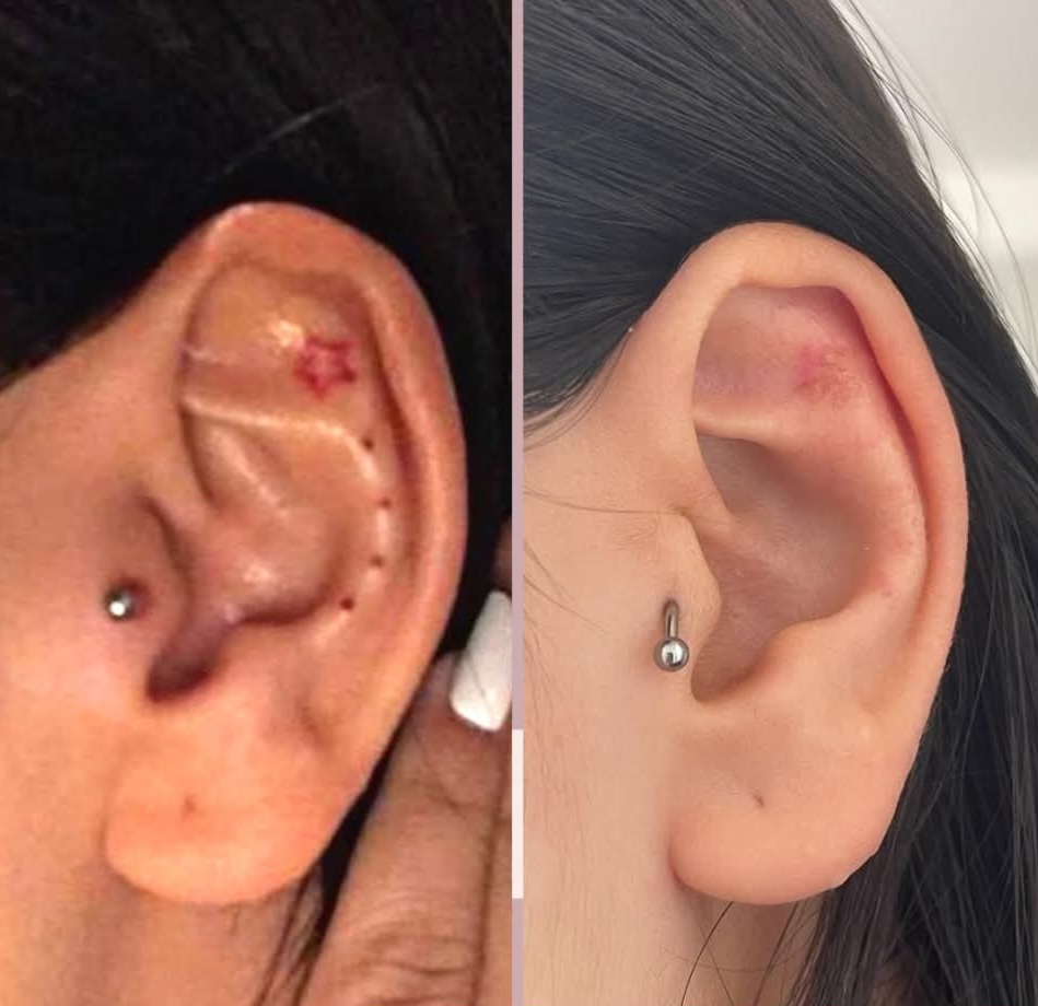 Remoção de Tatuagens a Laser
