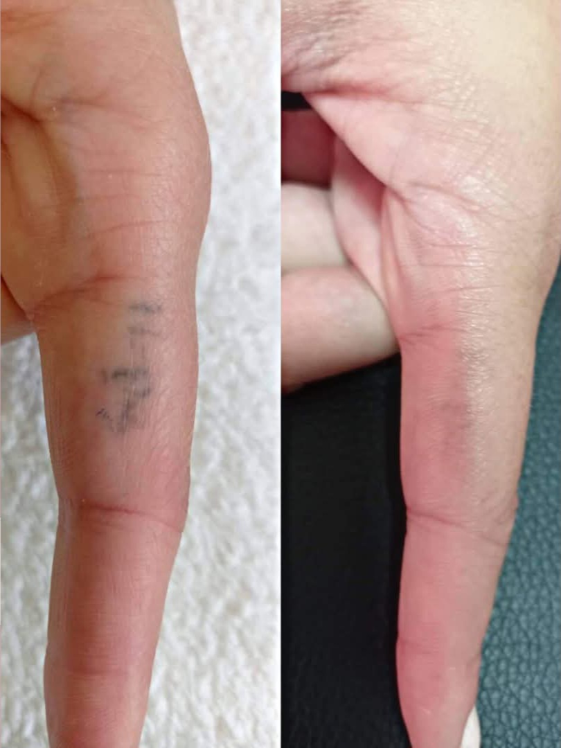 Remoção de Tatuagens a Laser
