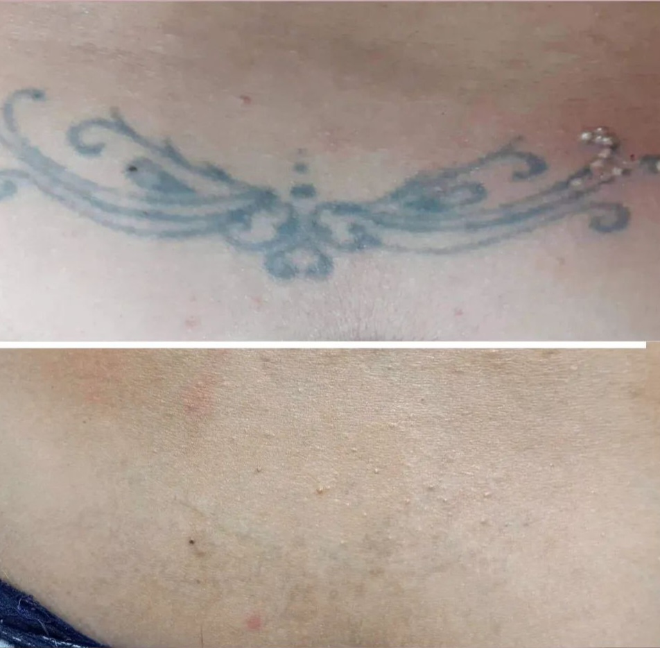 Remoção de Tatuagens a Laser