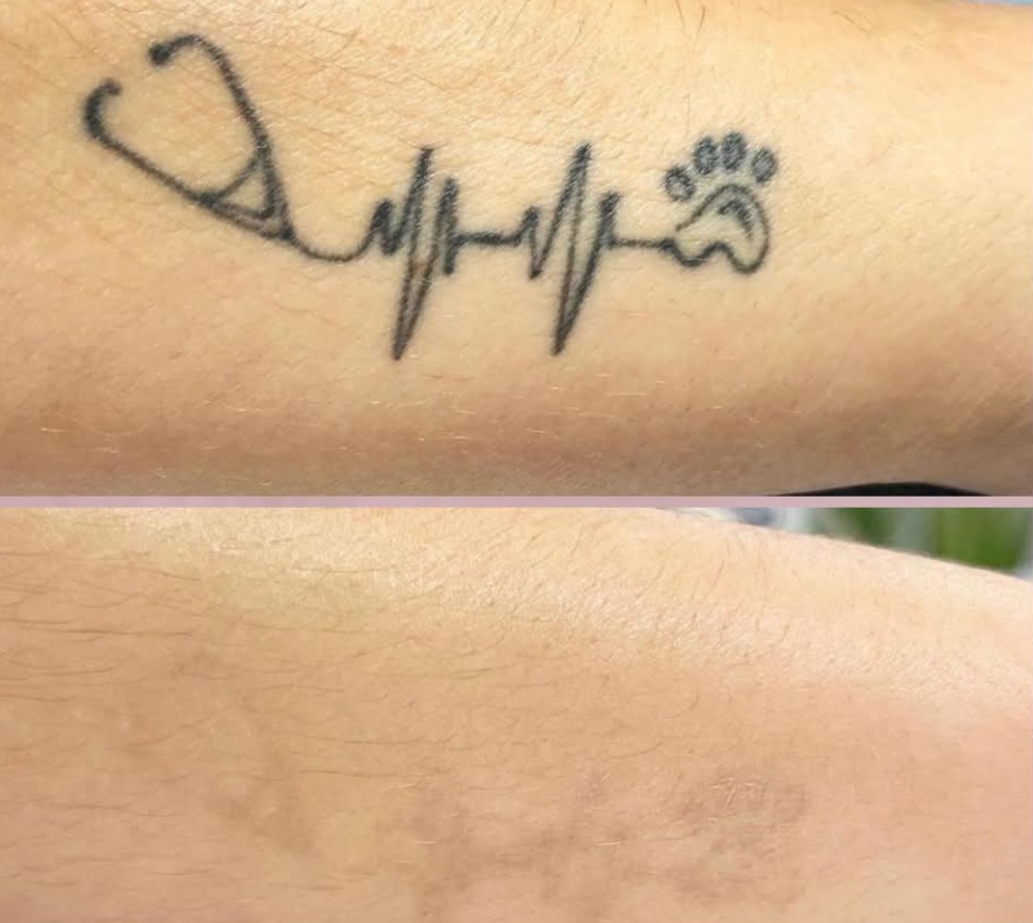 Remoção de Tatuagens a Laser