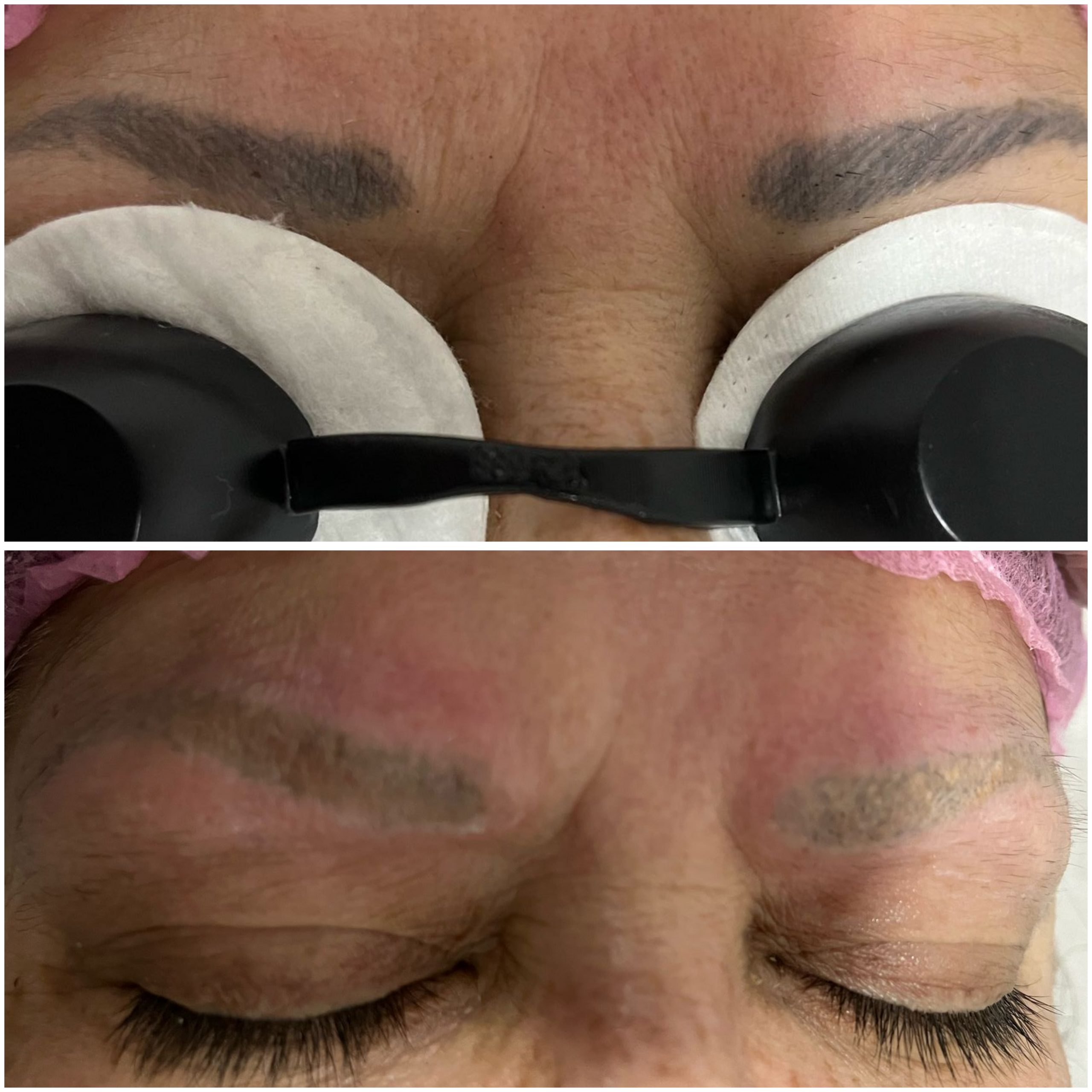 Remoção de Micropigmentação de Sobrancelhas a Laser