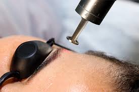 Remoção de Micropigmentação de Sobrancelhas a Laser